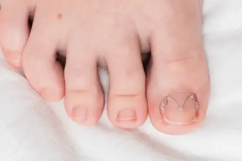 Zbliżenie na stopę z widocznymi paznokciami, w tym jednym z drutem korygującym.