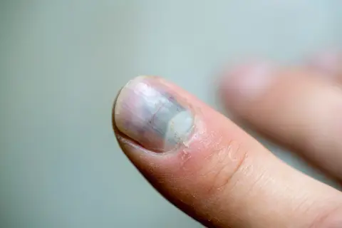 Uszkodzony paznokieć z siniakiem pod płytką i zaczerwienieniem wokół.