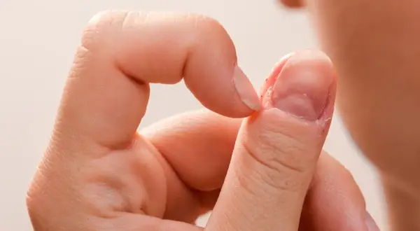 Zbliżenie na palec z widocznymi wgłębieniami i nierównościami na paznokciu.
