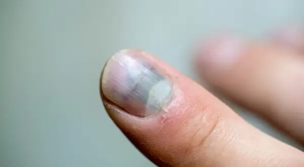 Uszkodzony paznokieć z siniakiem pod płytką i zaczerwienieniem wokół.